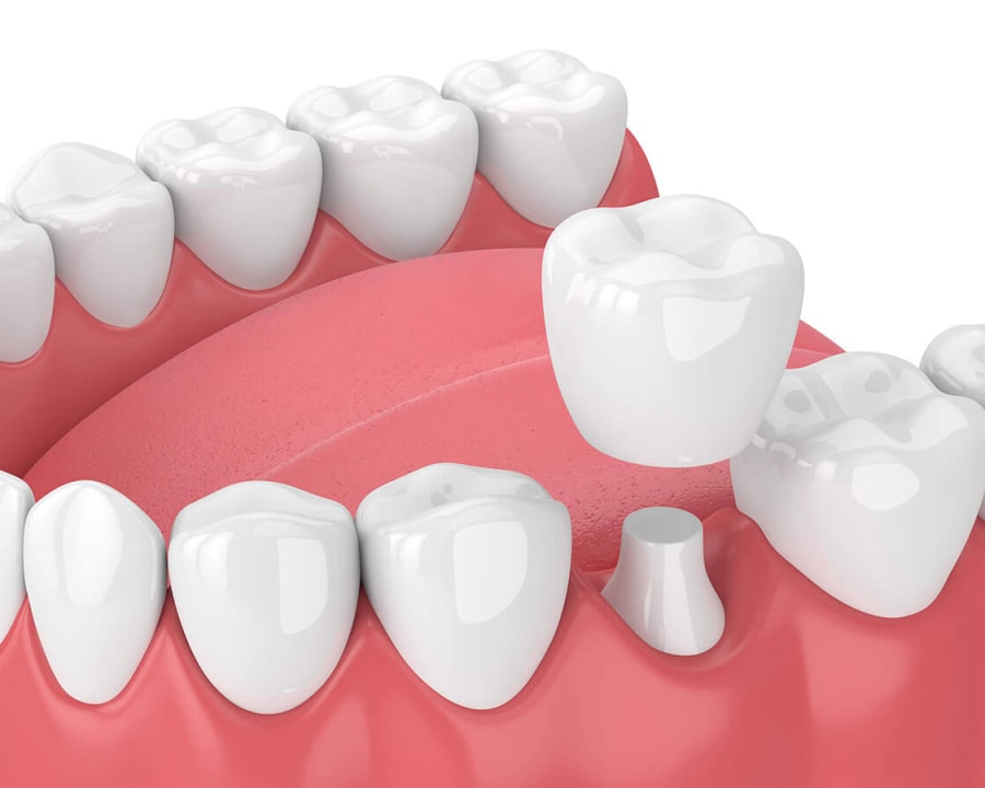 Dental Bridges and Crowns at Seycove Dental in North Vancouver
