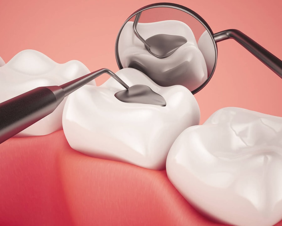 Composite Fillings at Seycove Dental, BC