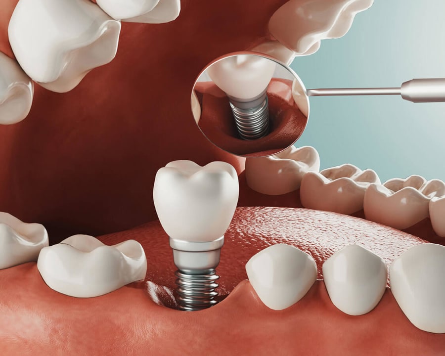 Dental Implants | Seycove Dental