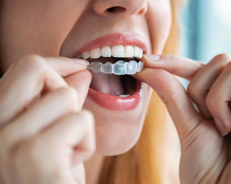 What is Invisalign? Seycove Dental in North Vancouver